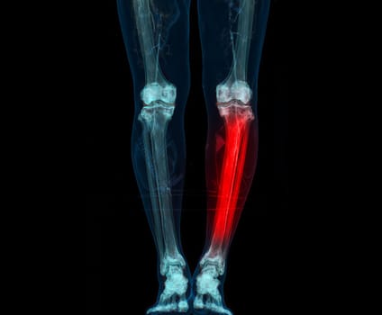 3D render of lower extremity or legs isolated on black background.