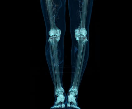 3D render of lower extremity or legs isolated on black background.