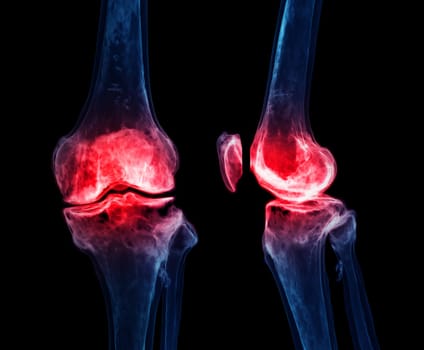 3d renderering of the knee joint isolated on black background Showing pain area.