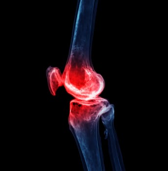 3d renderering of the knee joint isolated on black background Showing pain area.