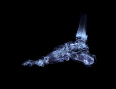 3D rendering of the foot bones for diagnosis bone fracture and rheumatoid arthritis from CT scannner.