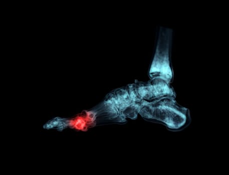 3D rendering of the foot bones for diagnosis bone fracture and rheumatoid arthritis from CT scannner.