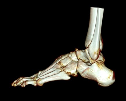 3D rendering of the foot bones for diagnosis bone fracture and rheumatoid arthritis from CT scannner.