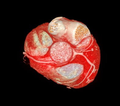 CT Cardiac 3D or CTA coronary artery for prevention and screening coronary artery diseases.