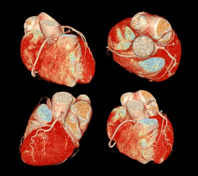 CT Cardiac 3D or CTA coronary artery for prevention and screening coronary artery diseases.