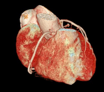 CT Cardiac 3D or CTA coronary artery for prevention and screening coronary artery diseases.