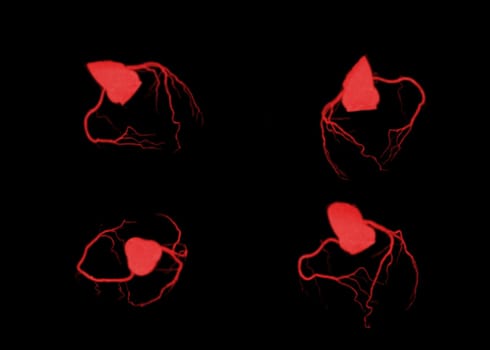 Collection of CT Cardiac 3D or CTA coronary artery for Check up coronary artery diseases.