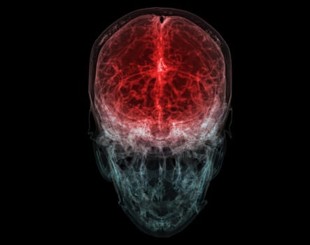 3D rendered medically accurate illustration of the cerebral artery of the head