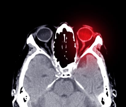 CT scan of the brain sagittal view for diagnosis brain tumor,stroke diseases and vascular diseases.