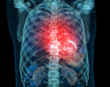 Human heart attack pain as an anatomy medical disease concept with a person suffering from a cardiac illness as a painful coronary event with 3D illustration .