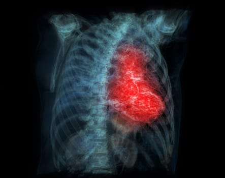 Human heart attack pain as an anatomy medical disease concept with a person suffering from a cardiac illness as a painful coronary event with 3D illustration .