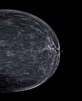 X-ray Digital Mammogram or mammography of both side breast Standard views are bilateral craniocaudal (CC) for screening Breast cancer and evidence of malignancy .