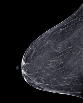 X-ray Digital Mammogram or mammography of both side breast Standard views are bilateral craniocaudal (CC) for screening Breast cancer and evidence of malignancy .