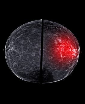 X-ray Digital Mammogram or mammography of both side breast Standard views are bilateral craniocaudal (CC) for screening Breast cancer and evidence of malignancy .