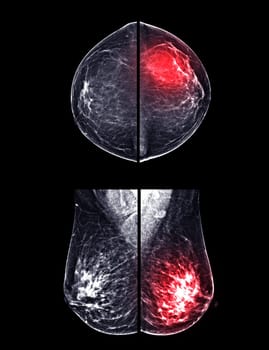 X-ray Digital Mammogram or mammography of both side breast CC view and MLO for screening Breast cancer and evidence of malignancy .