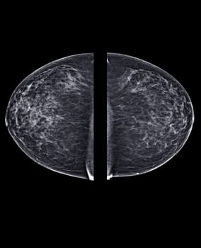 X-ray Digital Mammogram or mammography of both side breast Standard views are bilateral craniocaudal (CC) for screening Breast cancer and evidence of malignancy .