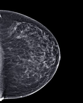 X-ray Digital Mammogram or mammography of both side breast Standard views are bilateral craniocaudal (CC) for screening Breast cancer and evidence of malignancy .