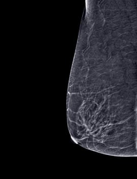 X-ray Digital Mammogram or mammography of both side breast Standard views are mediolateral oblique (MLO) views for screening Breast cancer and evidence of malignancy .