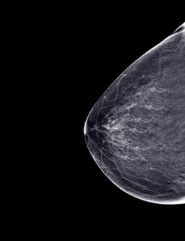 X-ray Digital Mammogram or mammography of both side breast Standard views are bilateral craniocaudal (CC) for screening Breast cancer and evidence of malignancy .