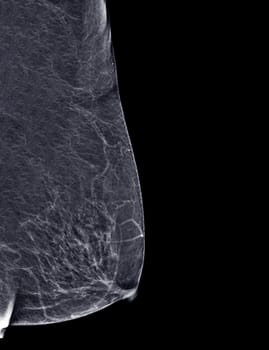 X-ray Digital Mammogram or mammography of both side breast Standard views are mediolateral oblique (MLO) views for screening Breast cancer and evidence of malignancy .