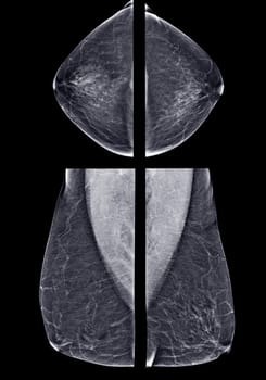 X-ray Digital Mammogram or mammography of both side breast CC view and MLO for screening Breast cancer and evidence of malignancy .