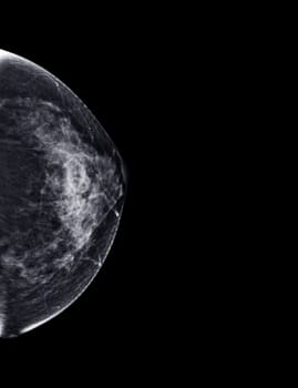 X-ray Digital Mammogram or mammography of both side breast Standard views are bilateral craniocaudal (CC) for screening Breast cancer and evidence of malignancy .