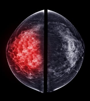 X-ray Digital Mammogram or mammography of both side breast Standard views are bilateral craniocaudal (CC) for screening Breast cancer and evidence of malignancy .