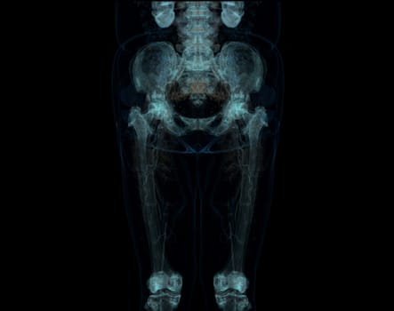 CT scan of lower extremity ,3D illustration of Femur bone , knee joint , leg and foot .