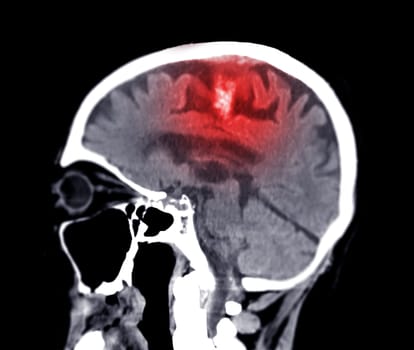 CT scan of the brain sagittal view for diagnosis brain tumor,stroke diseases and vascular diseases.