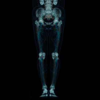 CT scan of lower extremity ,3D illustration of Femur bone , knee joint , leg and foot .