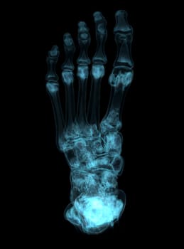 3D rendering of the foot bones for diagnosis bone fracture and rheumatoid arthritis from CT scannner.