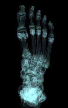 3D rendering of the foot bones for diagnosis bone fracture and rheumatoid arthritis from CT scannner.