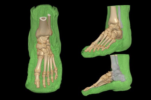 3D rendering of the foot bones for diagnosis bone fracture and rheumatoid arthritis from CT scannner.