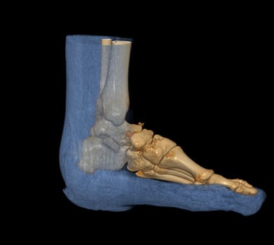 3D rendering of the foot bones for diagnosis bone fracture and rheumatoid arthritis from CT scannner.