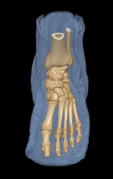 3D rendering of the foot bones for diagnosis bone fracture and rheumatoid arthritis from CT scannner.