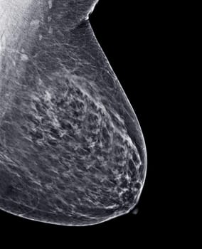 X-ray Digital Mammogram or mammography of both side breast Standard views are mediolateral oblique (MLO) views for screening Breast cancer and evidence of malignancy .