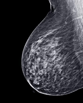 X-ray Digital Mammogram or mammography of both side breast Standard views are mediolateral oblique (MLO) views for screening Breast cancer and evidence of malignancy .