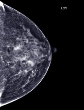 X-ray Digital Mammogram or mammography of both side breast Standard views are bilateral craniocaudal (CC) for screening Breast cancer and evidence of malignancy .