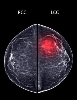 X-ray Digital Mammogram or mammography of both side breast Standard views are bilateral craniocaudal (CC) for screening Breast cancer and evidence of malignancy .