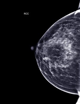 X-ray Digital Mammogram or mammography of both side breast Standard views are bilateral craniocaudal (CC) for screening Breast cancer and evidence of malignancy .