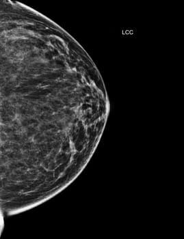 X-ray Digital Mammogram or mammography of both side breast Standard views are bilateral craniocaudal (CC) for screening Breast cancer and evidence of malignancy .