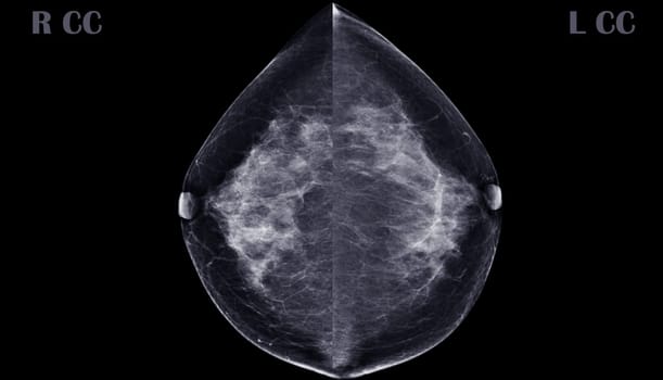 X-ray Digital Mammogram or mammography of both side breast CC view showing benign tumor BI-RADS 2 should be checked once a year.