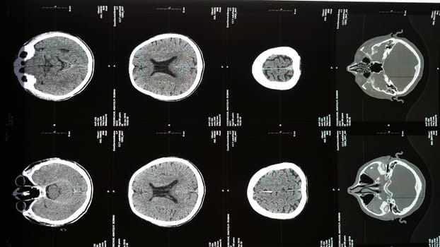 Magnetic resonance imaging of the brain from different sides, traumatic brain injury an 60 old male patient in the hospital, showing that the brain is affected. Examination by a neurologist, vertical