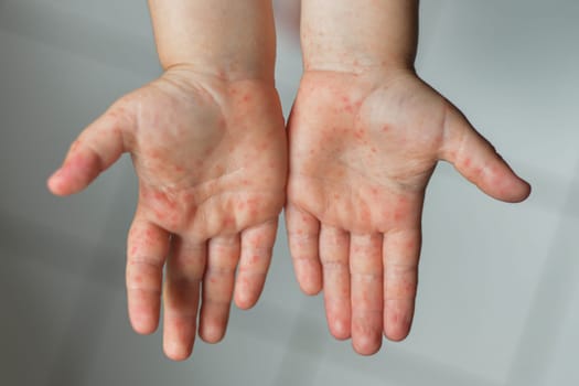 Enterovirus Legs hands mouth Rash on the body of a child Cocksackie virus