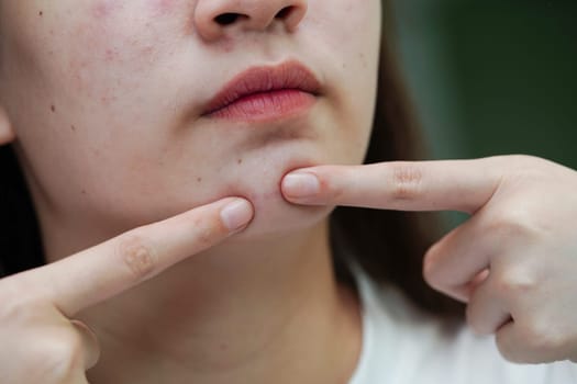 Acne pimple and scar on skin face, disorders of sebaceous glands, teenage girl skincare beauty problem.