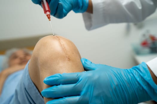 Asian doctor inject Hyaluronic acid platelet rich plasma into the knee of senior woman to walk without pain.