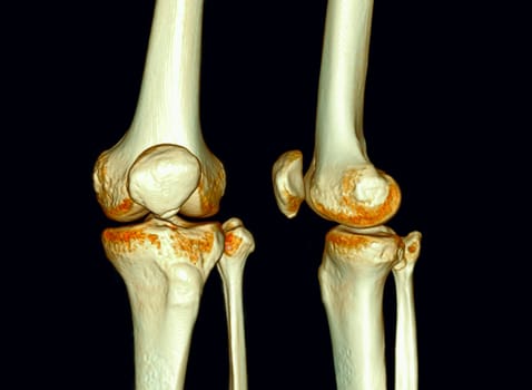 CT Scan of Knee joint 3D rendering .