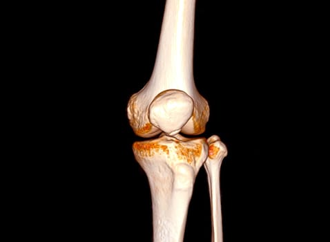 CT Scan of Knee joint 3D rendering .