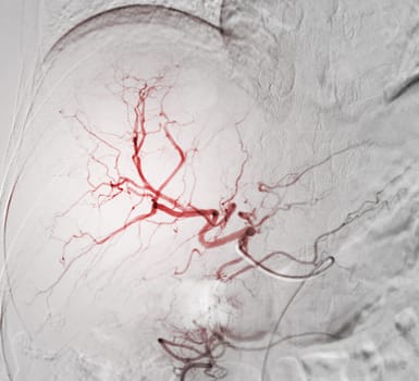 Imaging of TACE or Chemoembolization is a procedure that allows a dose of chemotherapy drugs to be administered directly to Liver tumor or HCC showing hepatic artery.