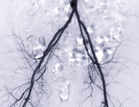 Femoral artery angiogram or angiography